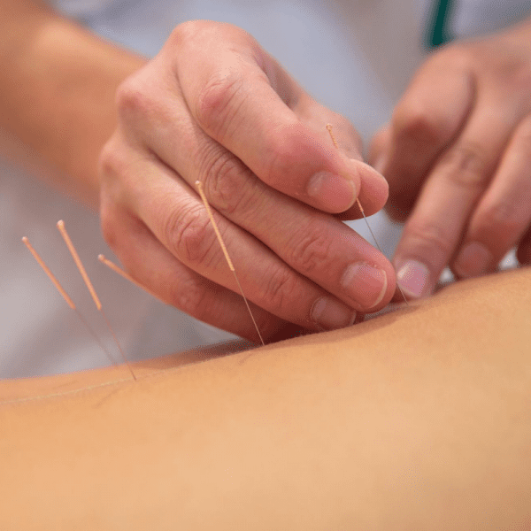 针灸 Acupuncture